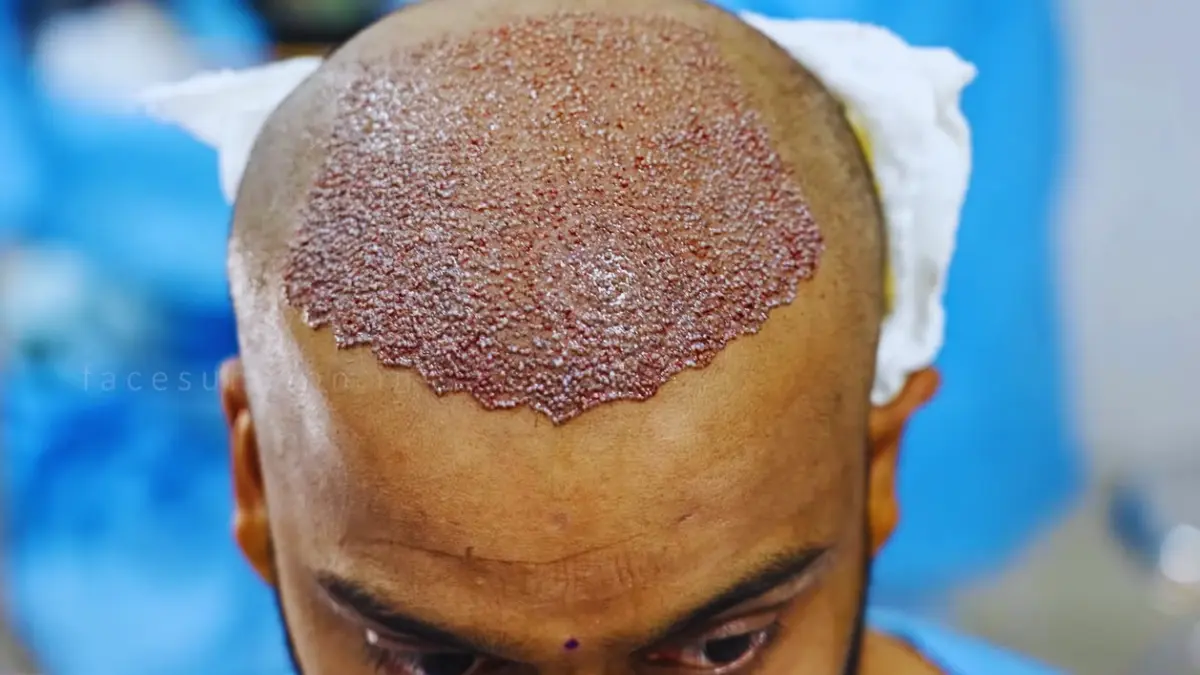 HAIR TRANSPLANT Overview and Definition