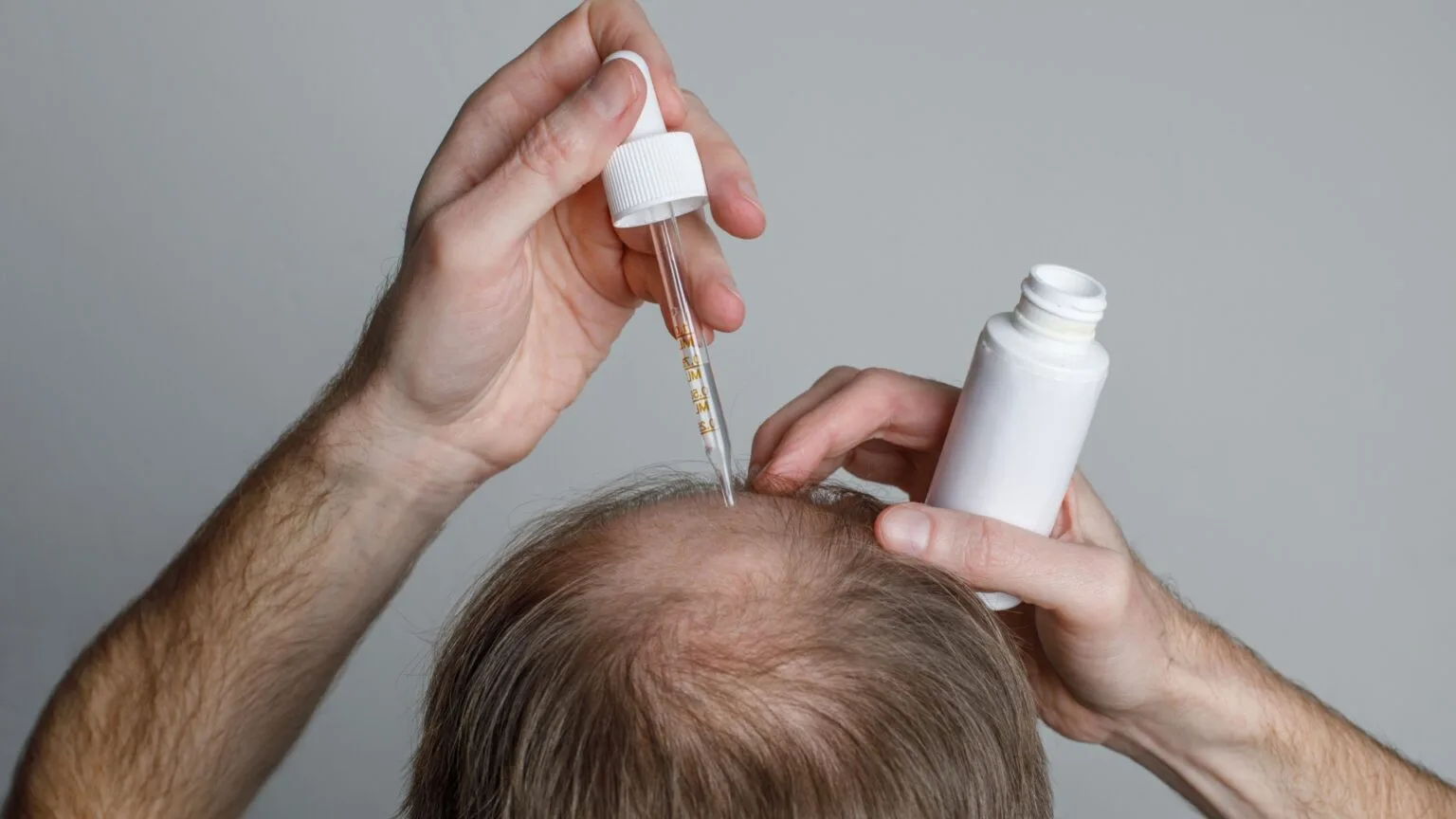 How to Minimize Side Effects of Minoxidil: A Complete Guide for Safe and Effective Hair Growth